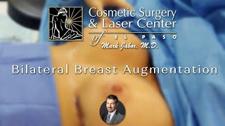 Bilateral Breast Augmentation - Dr. Mark Jabor