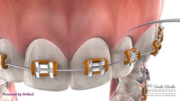 Flossing with braces