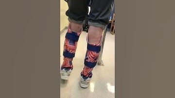 Teter O&P Patient Wearing Adjustable Bilateral AFO