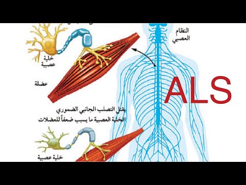 التصلب الجانبي الضموري ALS الأعراض والأسباب