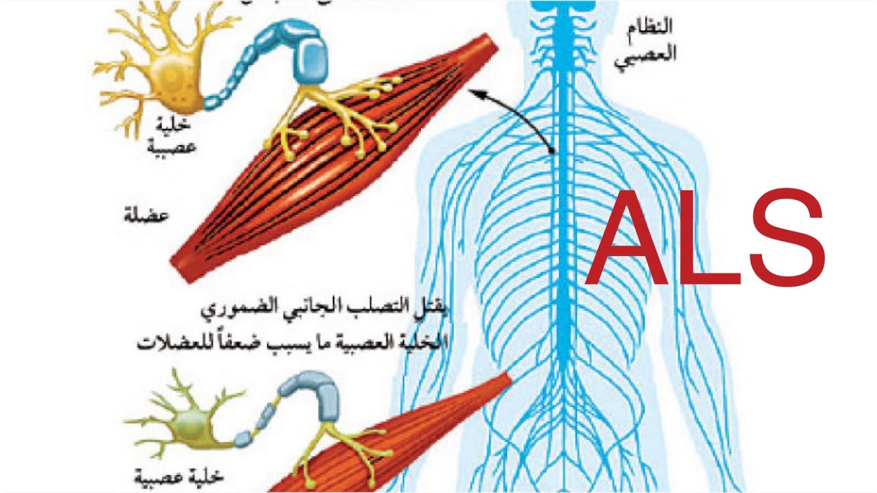 التصلب الجانبي الضموري ALS الأعراض والأسباب