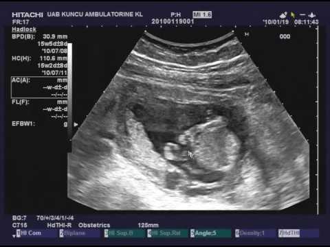 Video: Kas Nutinka, Jei Nėštumo Metu Kontroliuojate Kontracepciją?