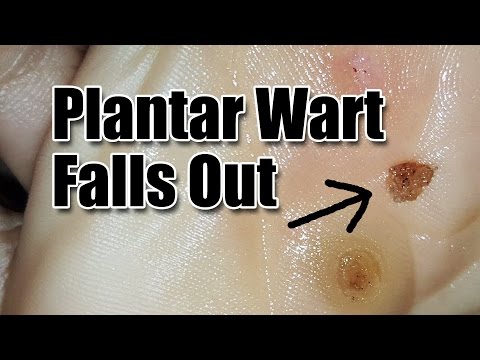 Video: Eteriska Oljor För Vårtor: Tea Tree Oil, Plantar Warts Och Mer