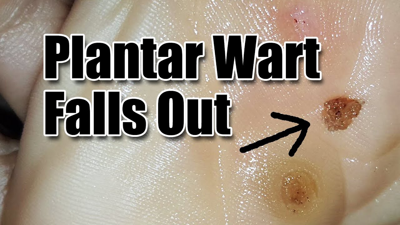 Does nail polish get rid of warts?