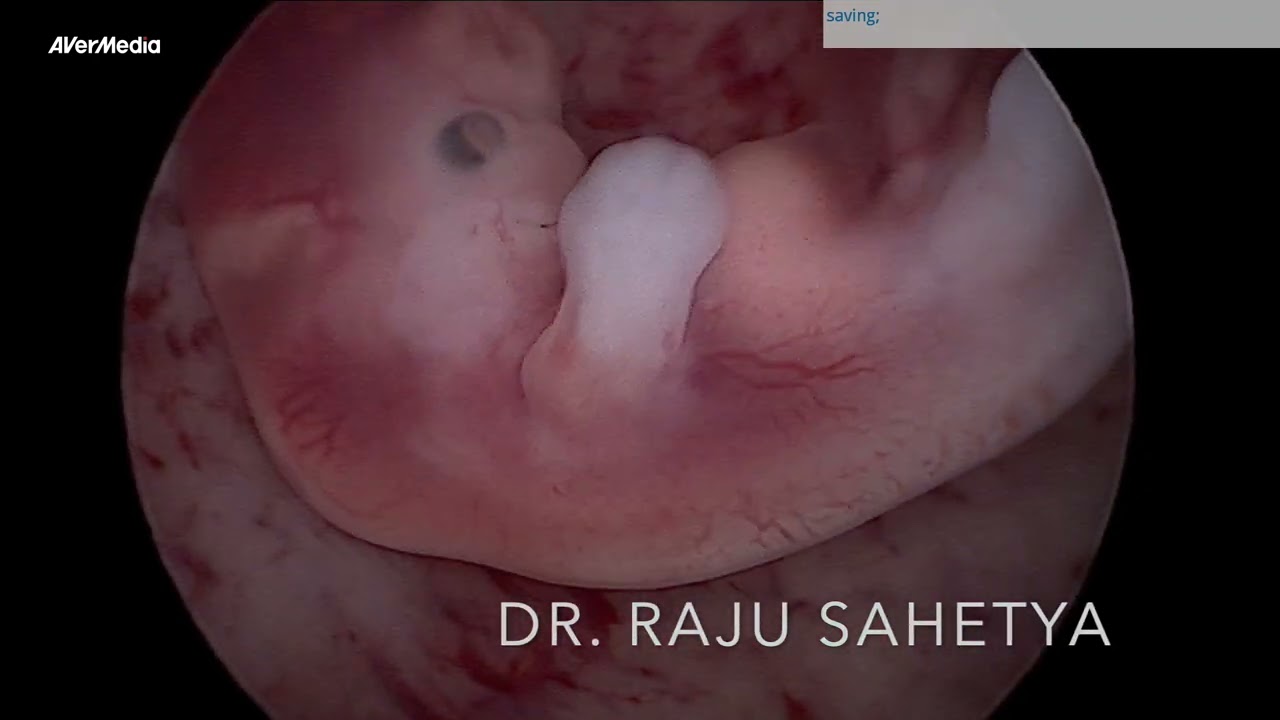 FETOSCOPY EMBRYOSCOPY
