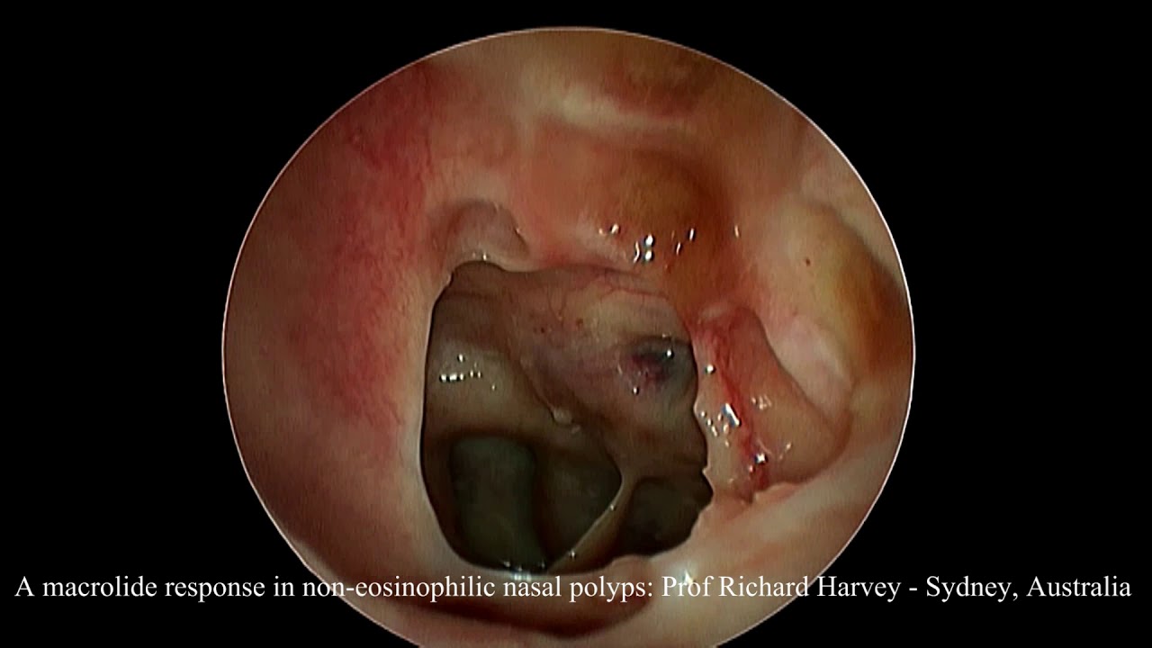 Modern Treatment For Nasal Polyps And Sinusitis