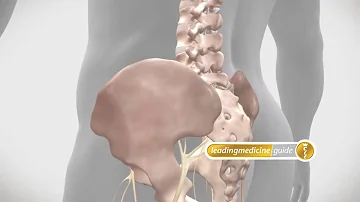 Welche Schmerztherapie bei Lumboischialgie?