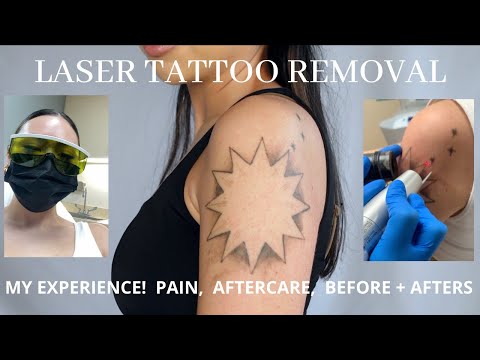 My Laser Tattoo Removal Process w/ Aftercare, Healing, + Before/After