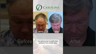 FUE Hair Transplant Charleston, SC. The use of implanter pins or DHI in hair transplant surgery.