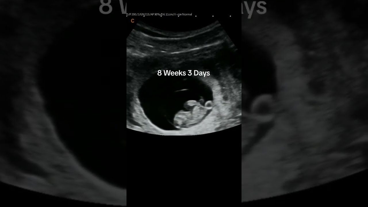 8 Weeks 3 Days Ultrasound Of Baby Moving In Utero