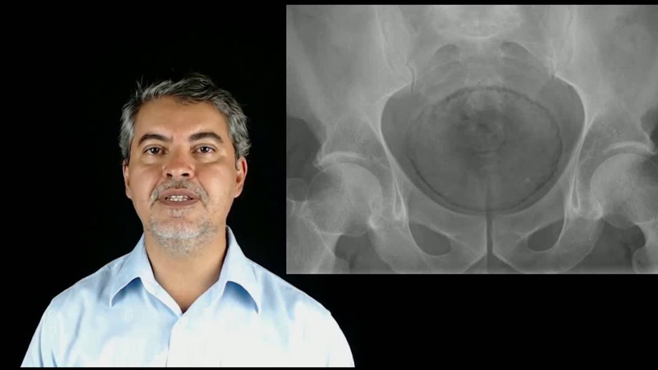 Pelve a sobre de flebólitos projeto múltiplos