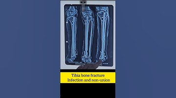 infection and non-union Tibia fibula bone fracture santosh #ilizarovsurgery #shortvideo