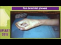 Pan brachial plexus - YouTube