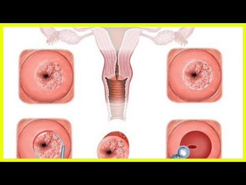 Video: Treatment Of Cervical Erosion With Folk Remedies, At Home