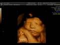34 Week 3D ultrasound Snip6