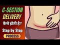 C-Section Delivery कैसे होती है? Procesure, 9 Month Pregnancy Care, Step by Step Explained in Hindi