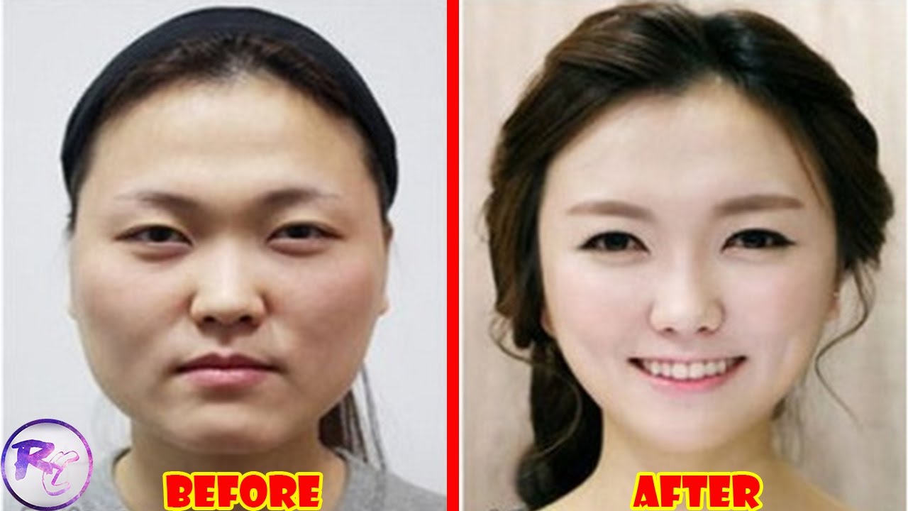 Korean Plastic Surgery Before and After Pictures YouTube