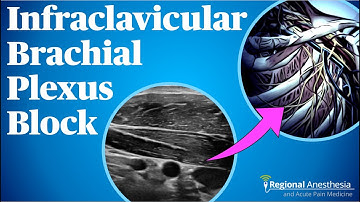 Infraclavicular Brachial Plexus Block