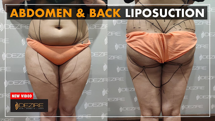 Back Fat Removal - Male & Female - LIPO 360 Before And After