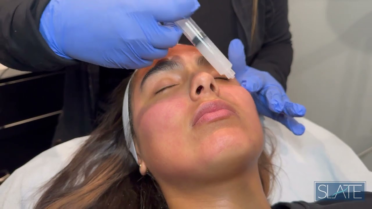 Sculptra + Microneedling at Slate Medspa New Jersey