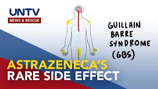 Extremely rare nerve disorder, possible AstraZeneca's side effect