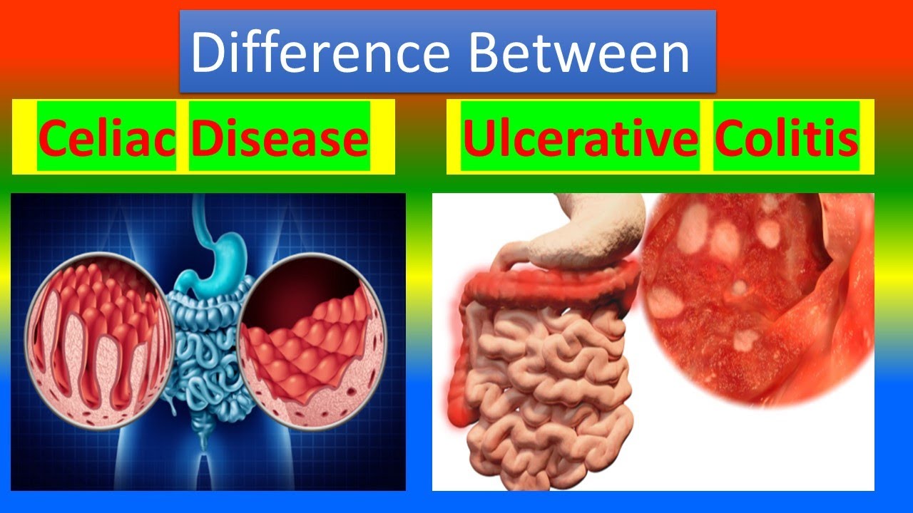 Collagenous Colitis And Celiac Disease – EJZV