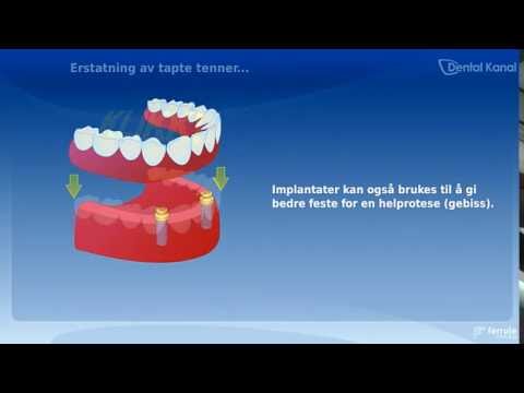 Video: Endostealimplantat: Tannimplantattyper Og Prosedyrer