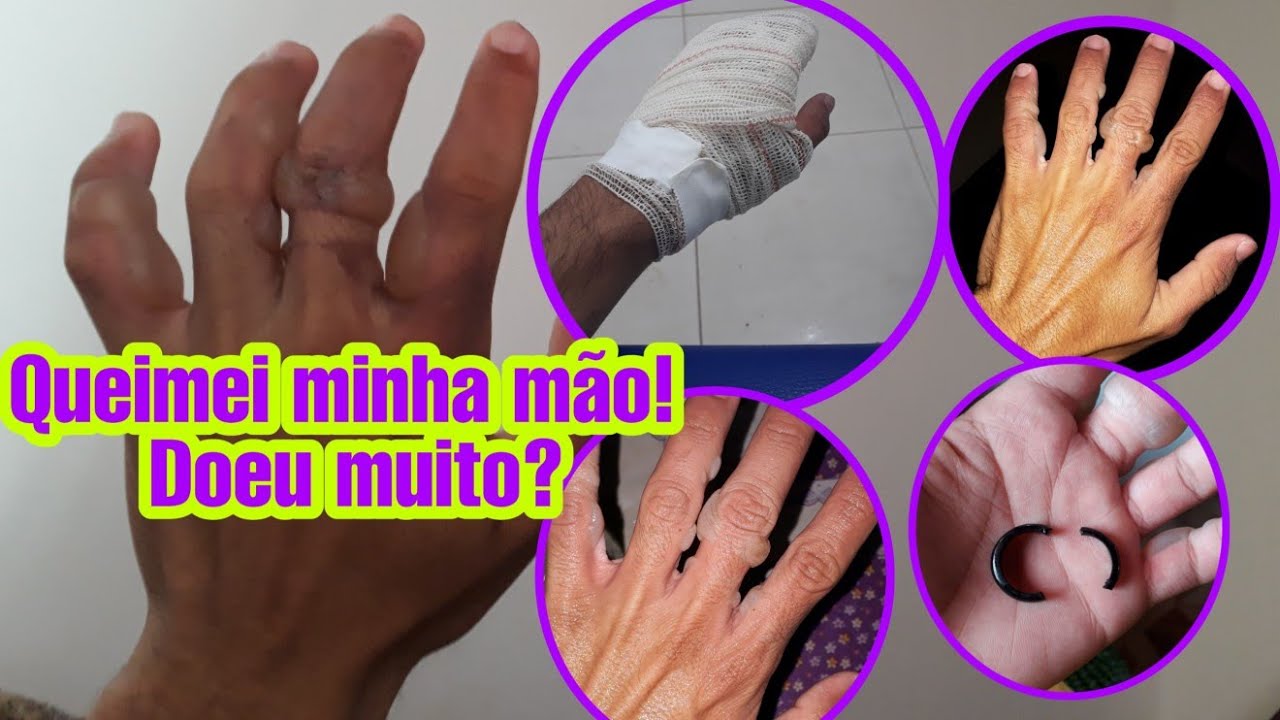 Como QUEIMEI minha MÃO totalmente!! - YouTube