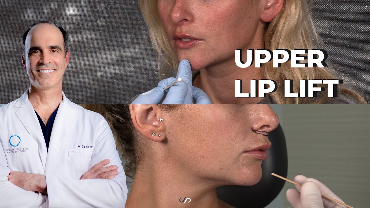 UPPER LIP LIFT BEFORE AND AFTER VIDEO | Dr. David Stoker