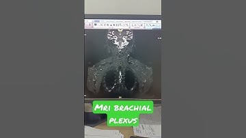 Brachial plexus imaging