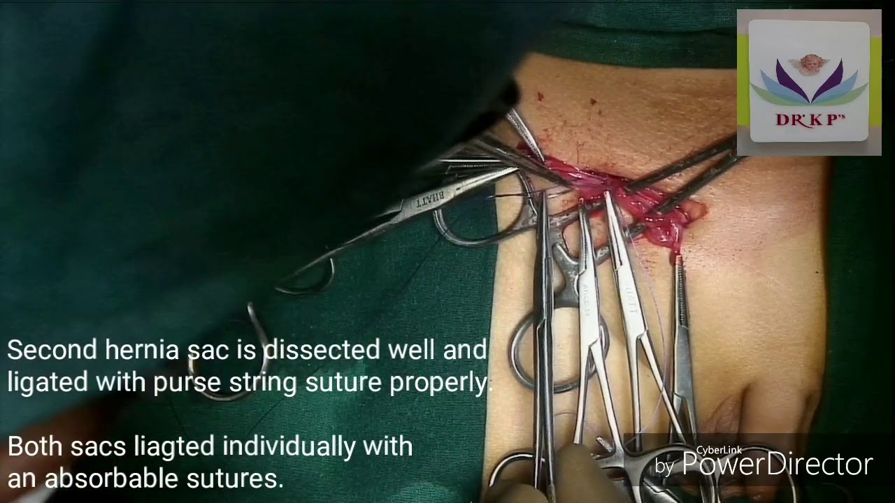 How to perform a Pursestring Suture: Proper Technique - YouTube
