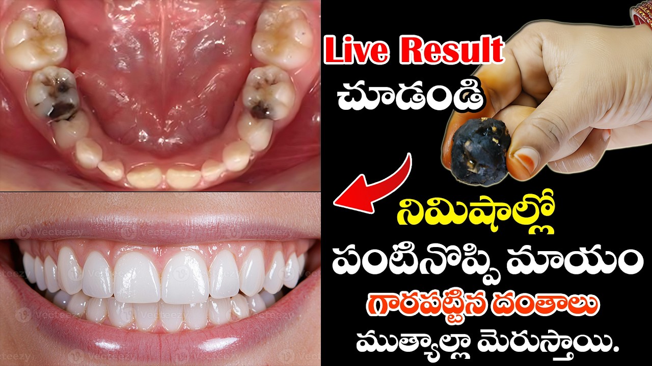 Dentist అవసరం లేకుండా పంటి నొప్పి పోతుంది! 🦷⚡ Yellow Teeth నుంచి Snow White Smile 😁