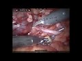 UPJ obstruction with large pelvis secondary to crossing vessel.