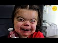 A Happy Kid who Doctors Recommended Terminating (Cornelia de Lange Syndrome)