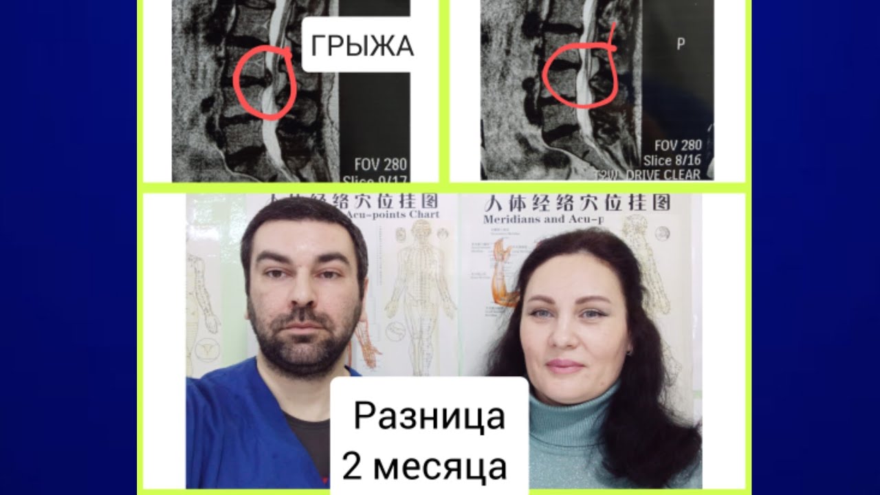 стеноз спинномозгового канала и грыжа межпозвонкового диска лечение без ...
