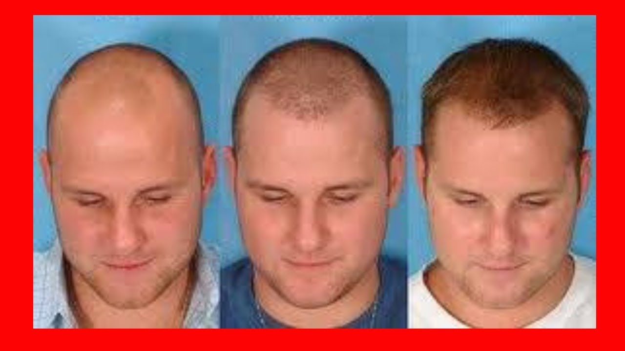 Месяц после пересадки волос. Прически при облысении. До и после пересадки волос мужчинам. Прически после пересадки волос.