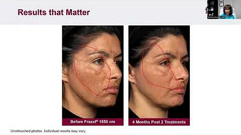 ThermaFrax with Dr Marina Buckley