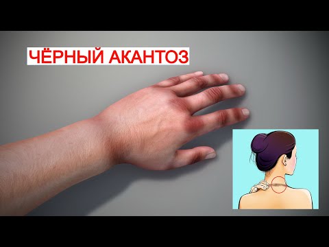 Чёрный Акантоз