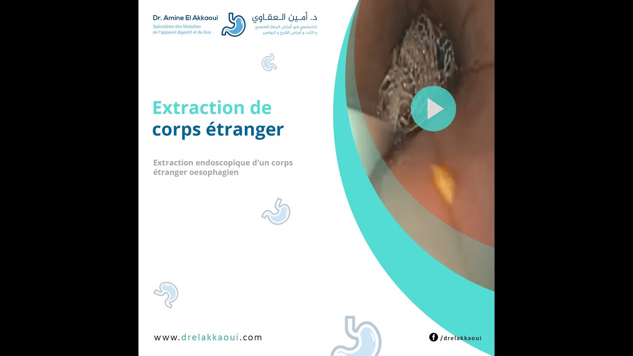 Comment Obtenir L’Extraction D’Un Corps Étranger De L’Oeil YINSBK — free download
