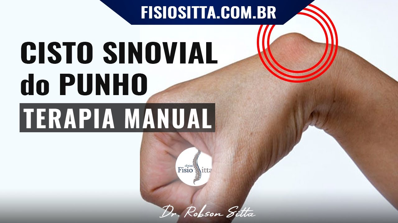 Cisto sinovial: o que é, sintomas, causas e tratamento - Tua Saúde