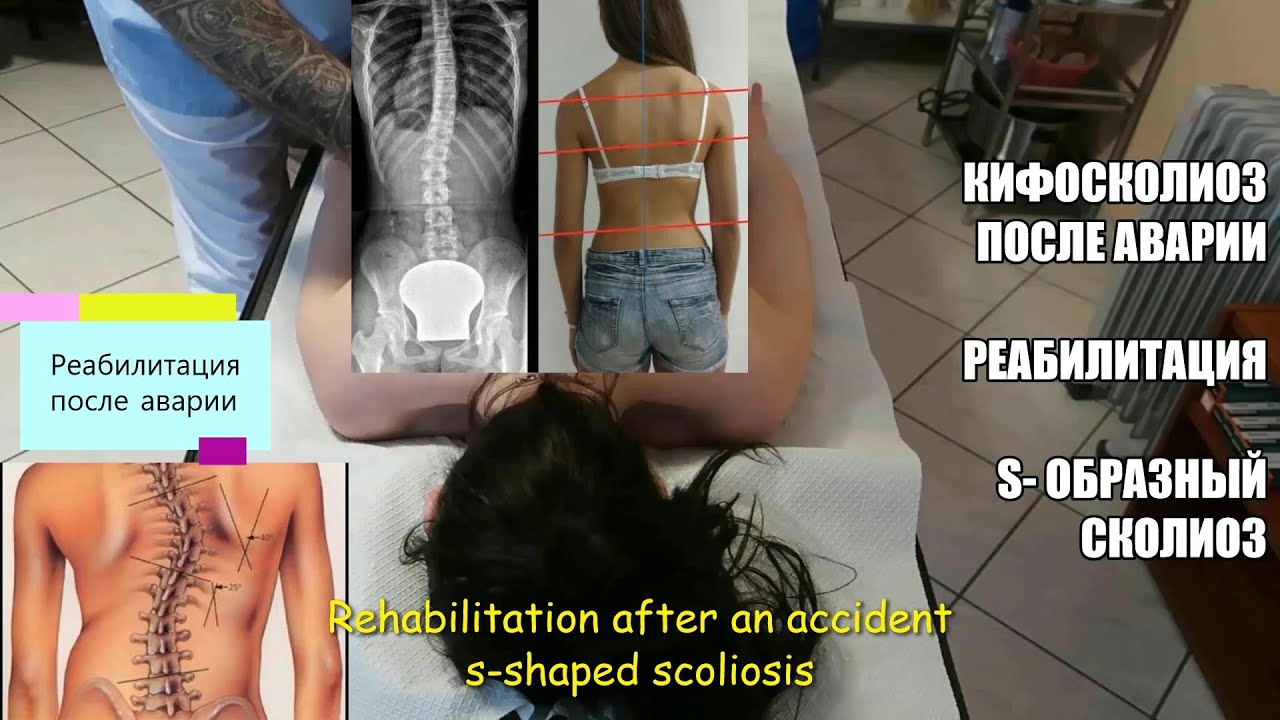 Массаж после аварии, часть1, s-образный сколиоз, Rehabilitation after ...