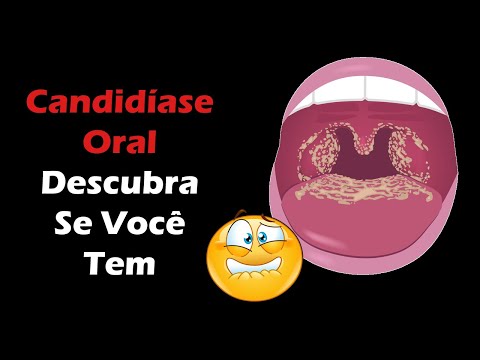 Vídeo: Língua Branca No Bebê: Candidíase E Outras Causas, Além De Tratamento