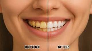 A Great Way for Teeth Whitening At Home.