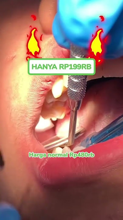 KHUSUS OKTOBER INI! Tambal Gigi Belakang hanya Rp199k aja, FDCiers! #fdcdentalclinic #tambalgigi