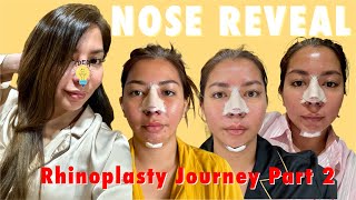 Rhinoplasty Journey Part 2 ( After Bandage The Final Look ) | Anna Magkawas