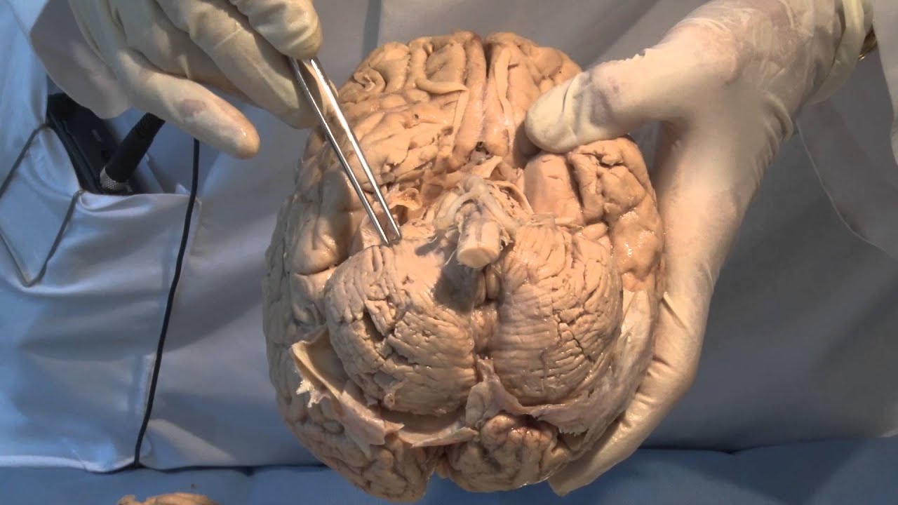 Neuroanatomy Video Lab Brain Dissections Ehsl Digital