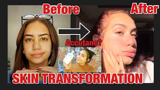ازاي تخلصت من حب الشباب و اثارة؟(نتيجه مضمونه ١٠٠٪؜)My Skin Transformation Journey