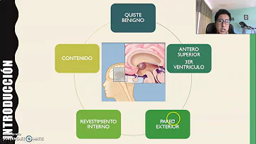 ¿Puede un quiste llegar al cerebro?