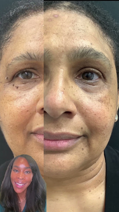 Brown growths on the face? Let's Discuss DPN's #shorts