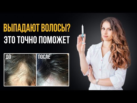 Video: Alopecia (skaldethed) Hos Kvinder - årsager, Behandling, Bedste Shampoo